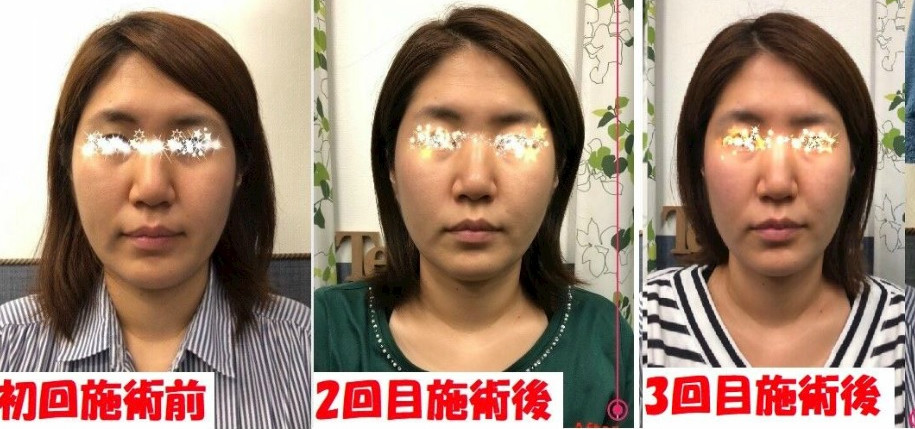 小顔矯正