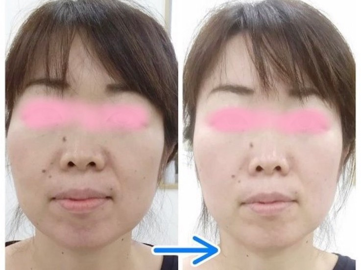 小顔矯正